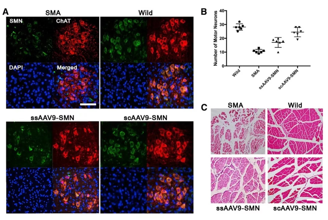 与时间赛跑，基于rAAV9载体胎儿基因治疗SMA新进展（一）